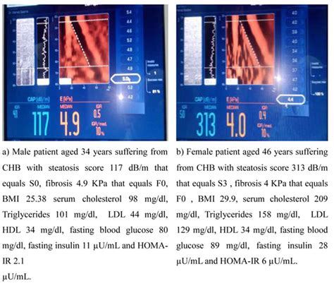 fibroscan results cap median 314.